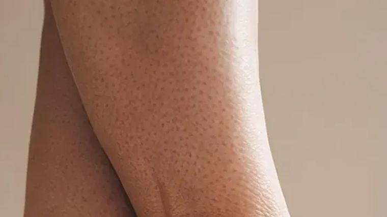 Dermatologlardan 'çilek bacak' uyarısı: Bilinçsiz peeling cilt bariyerine zarar veriyor